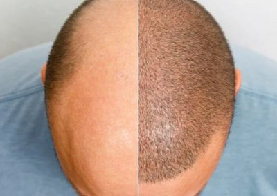 Amazing SMP for Male pattern baldness